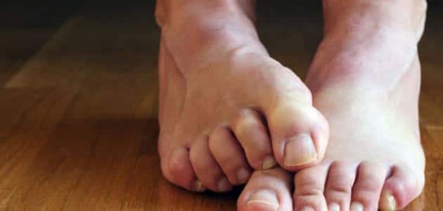 أسباب نقص ملح البوتاسيوم في الجسم 1 أعراض نقص الصوديوم والبوتاسيوم في الجسم