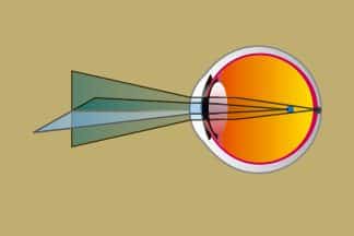 الاستجماتيزم أو اللابؤرية 3 astigmatic eye