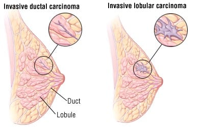 السرطان الفصيصي الموضعي ( LCIS )