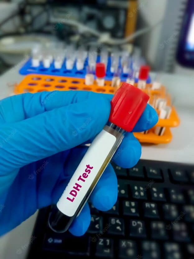 كل ما تودّ معرفته عن اختبار نازعة الهيدروجين لاكتات LDH 2024